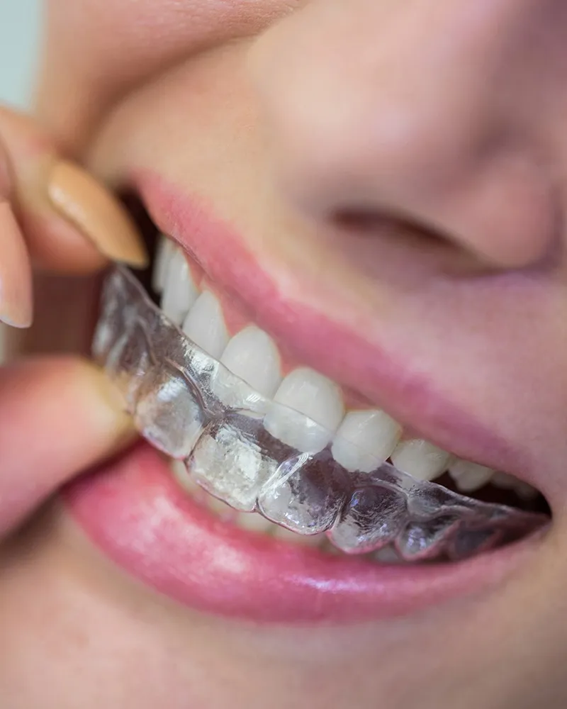 Girl with straight teeth putting on Invisalign clear aligner trays