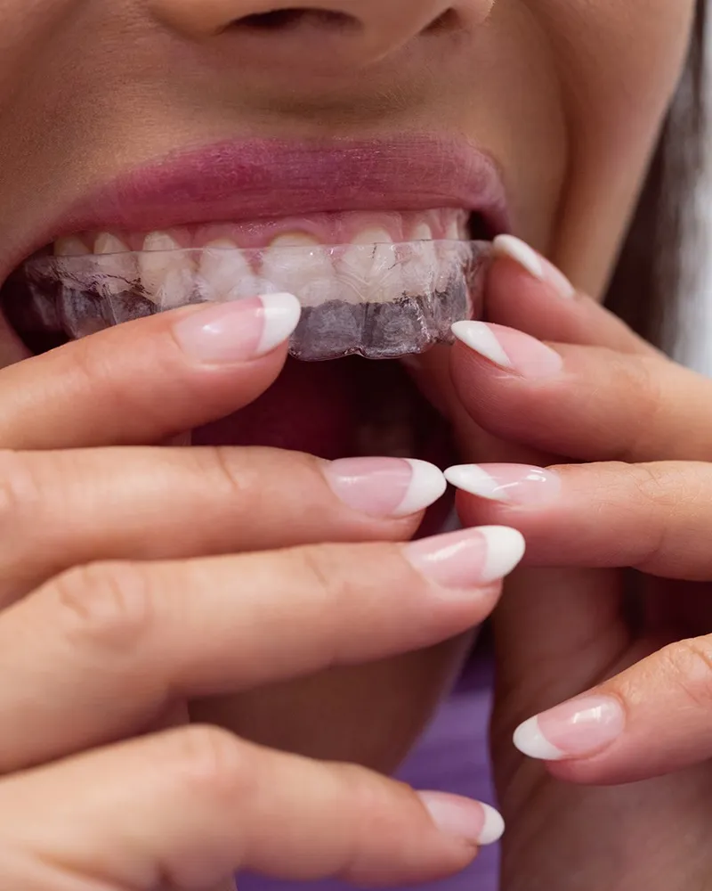 Woman putting in Invisalign clear aligner trays