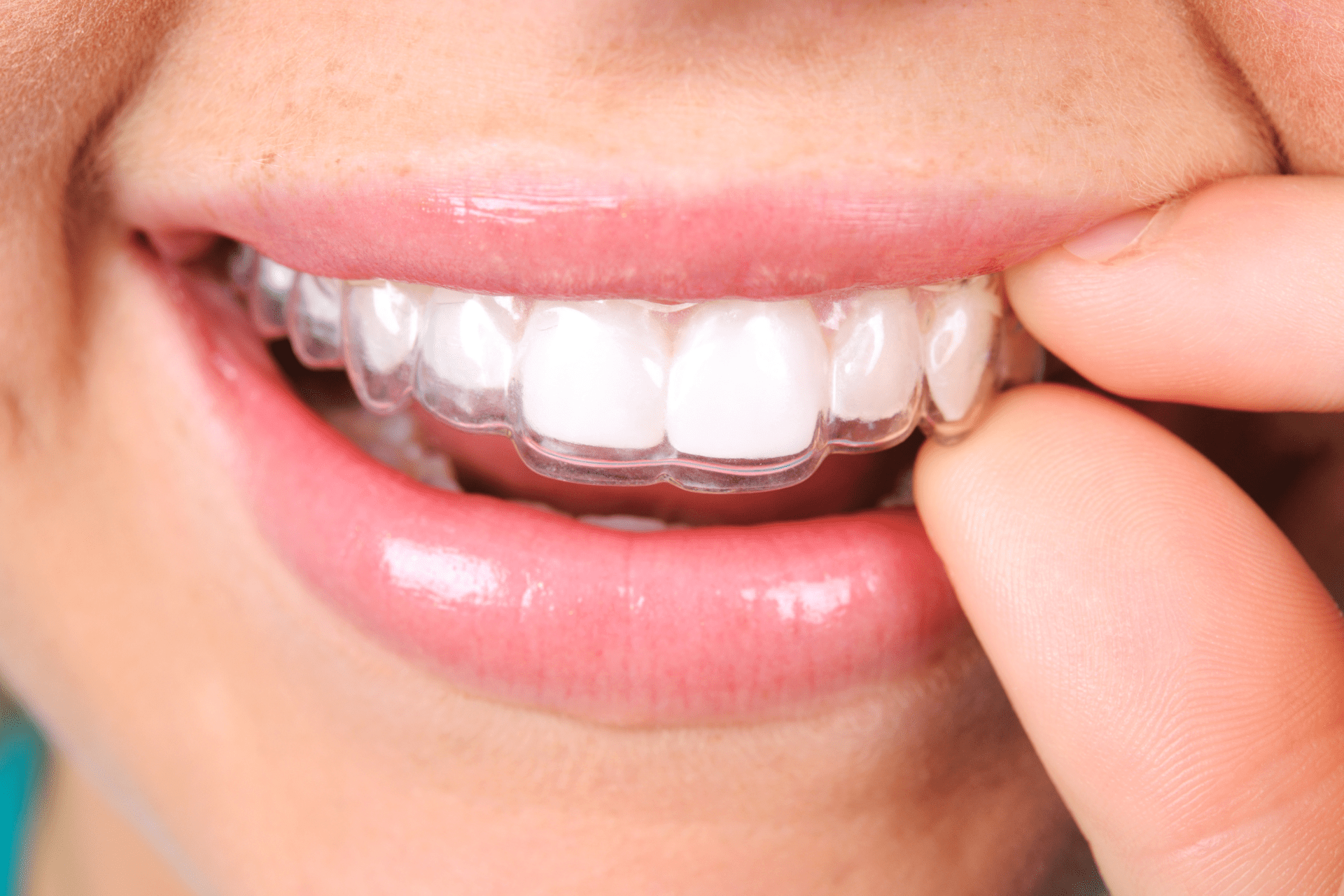 Invisalign correcting overbite