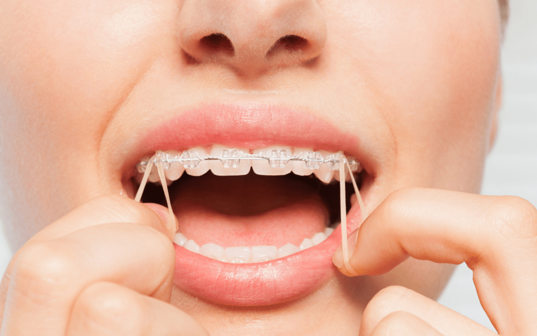 Ortho Options: Understanding Types of Braces and Cost in Minnesota