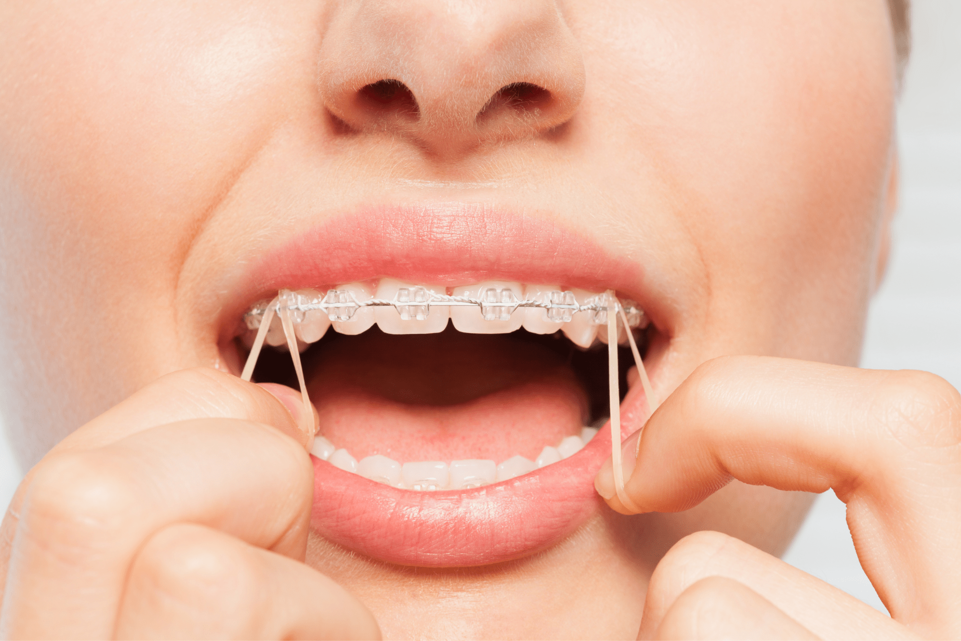 Invisalign